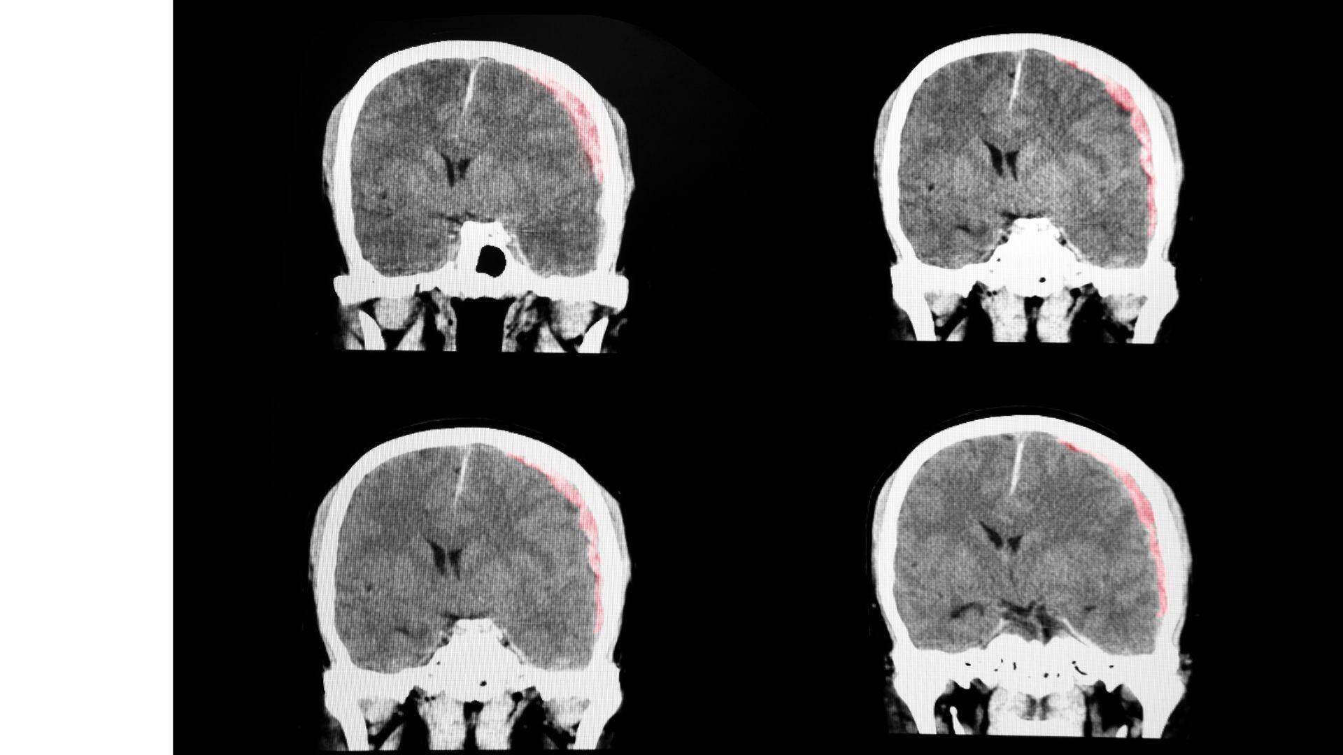 brain-scan-of-car-accident-patient-neurologist-new-jersey-jersey-city
